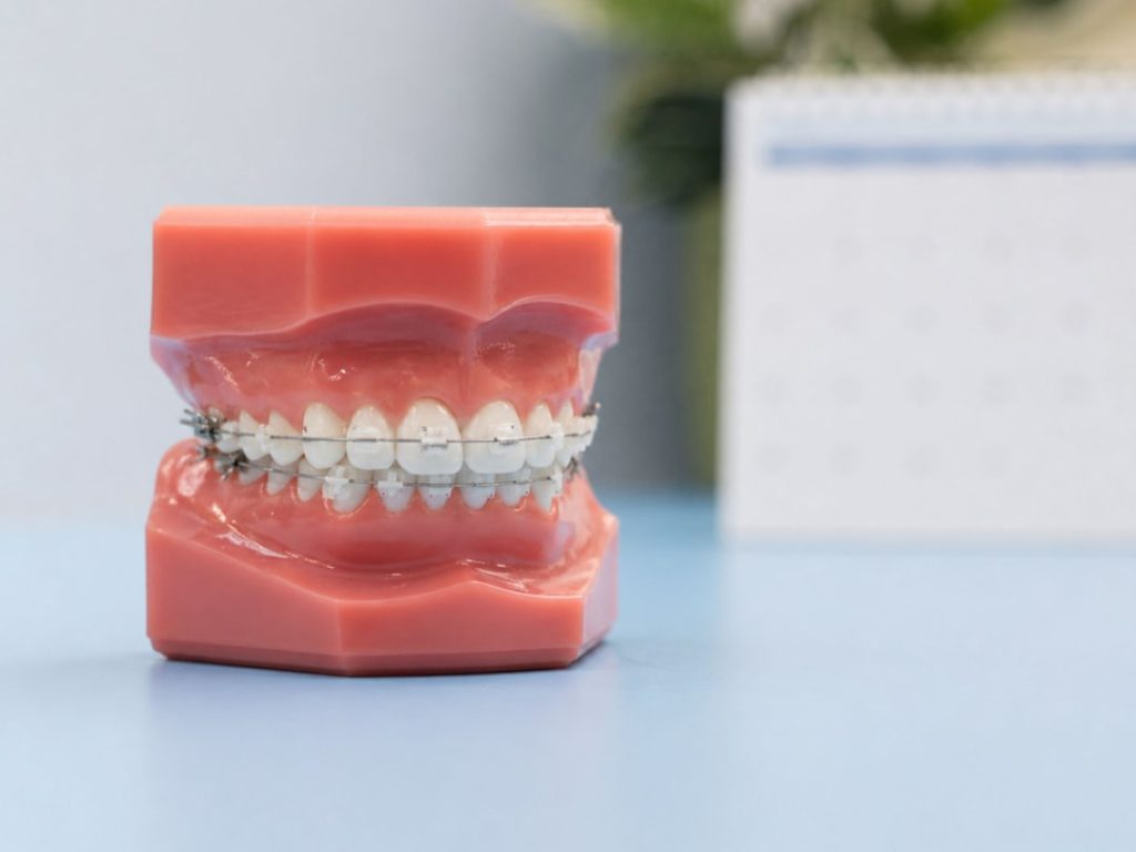 A dental braces display model on a light blue clinic counter, showing teeth, gums, wires and orthodontic details with soft shadows and reflections.